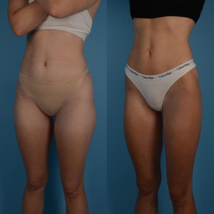 Before & After Liposuction Case 288 Left Oblique View in Toronto, ON