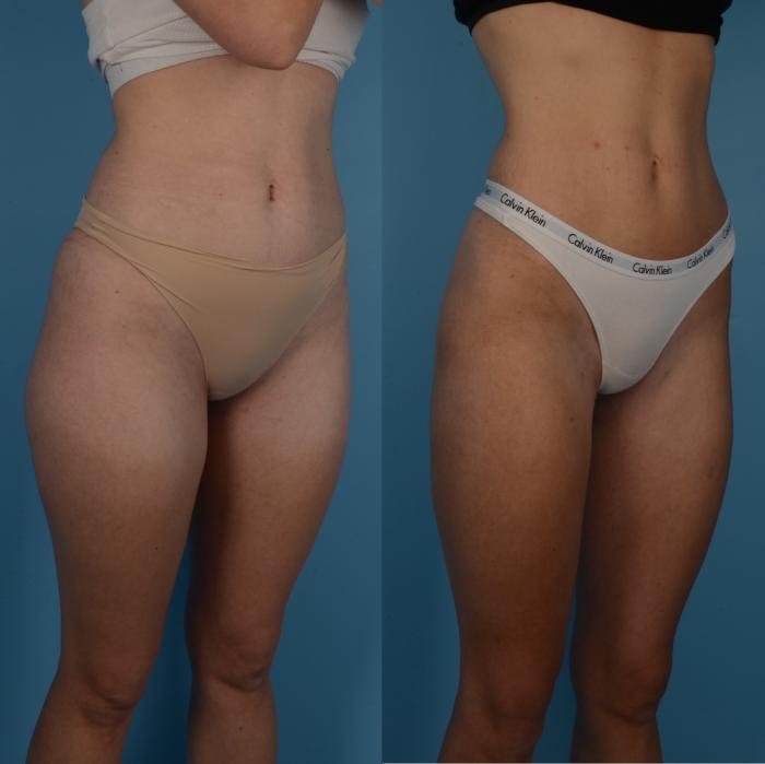 Before & After Liposuction Case 288 Right Oblique View in Toronto, ON