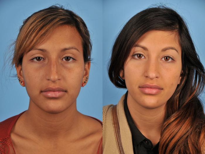 Before & After Rhinoplasty Case 11 View #1 View in Toronto, ON