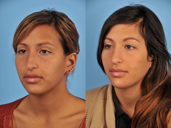 Before & After Rhinoplasty Case 11 View #2 View in Toronto, ON