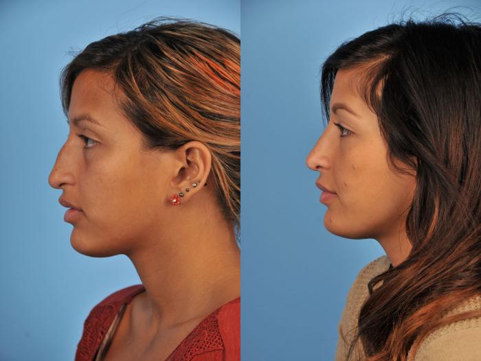 Before & After Rhinoplasty Case 11 View #3 View in Toronto, ON