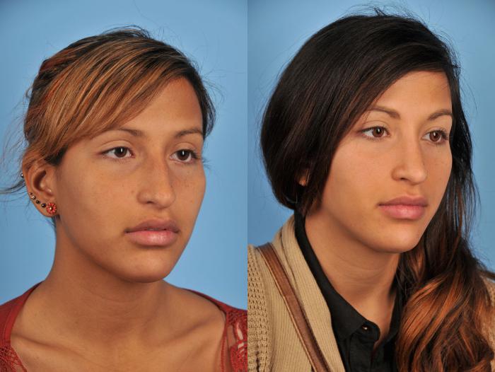 Before & After Rhinoplasty Case 11 View #4 View in Toronto, ON