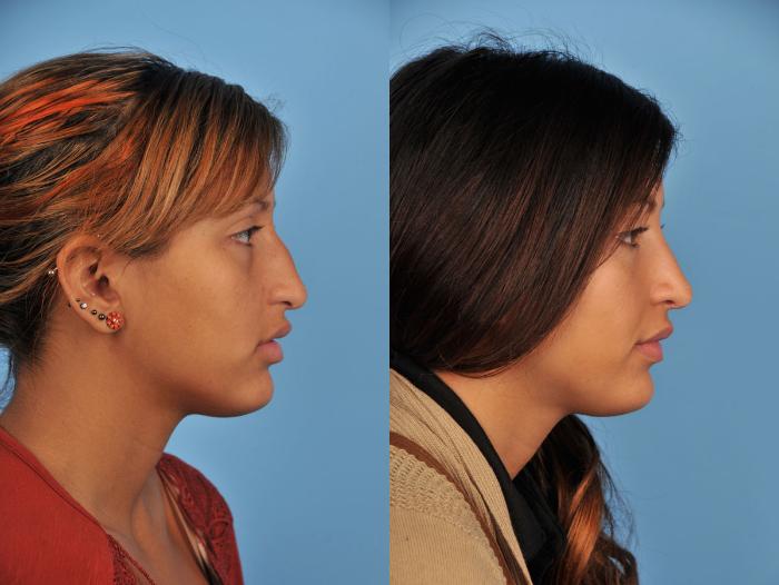 Before & After Rhinoplasty Case 11 View #5 View in Toronto, ON