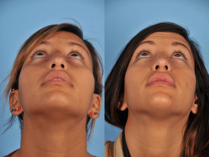 Before & After Rhinoplasty Case 11 View #6 View in Toronto, ON