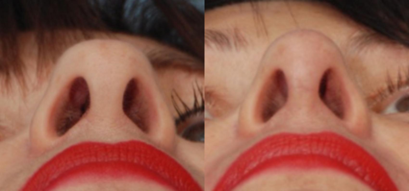 Before & After Rhinoplasty Case 148 View #1 View in Toronto, ON