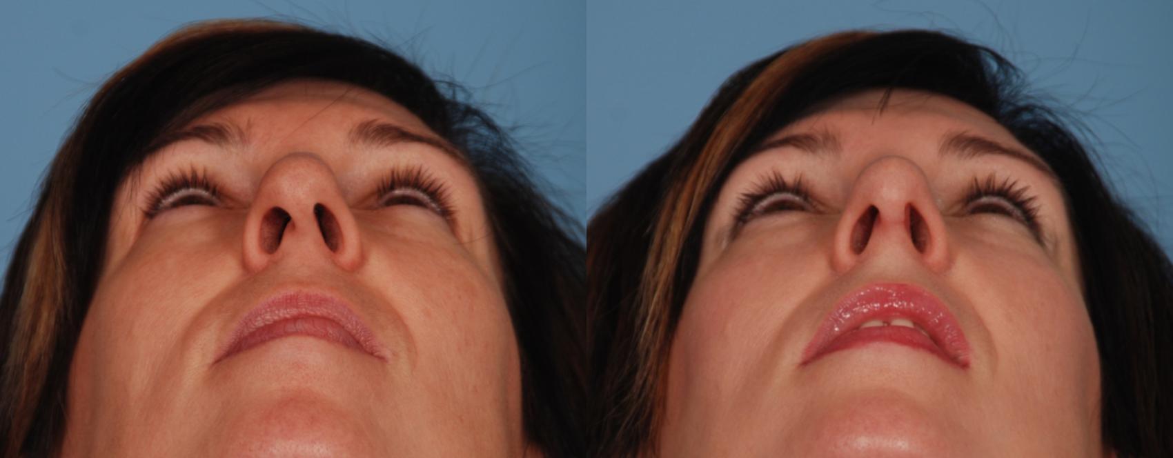 Before & After Rhinoplasty Case 166 View #1 View in Toronto, ON