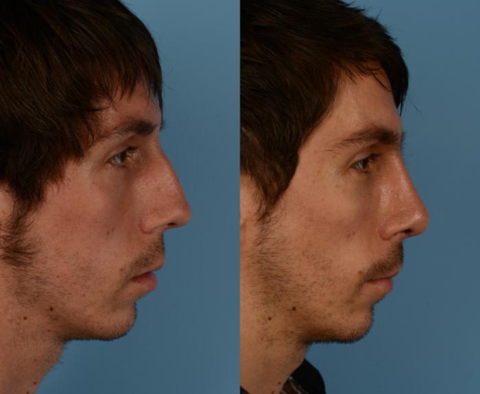 Before & After Rhinoplasty Case 192 View #1 View in Toronto, ON