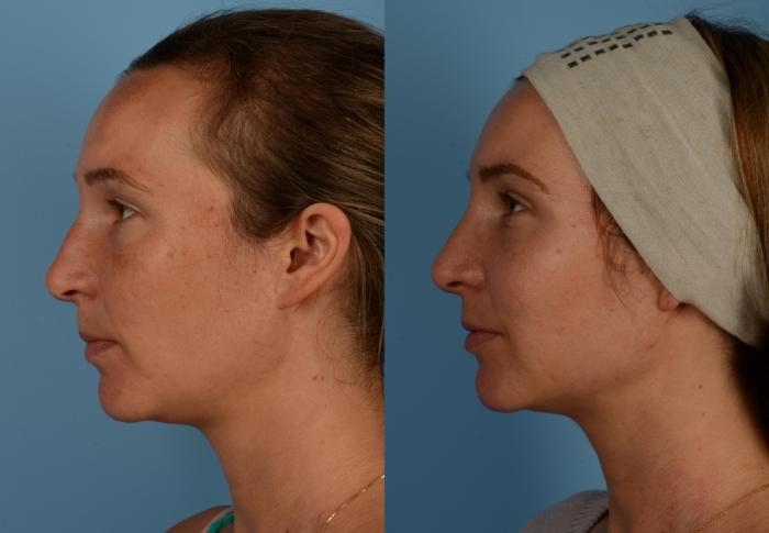 Before & After Rhinoplasty Case 203 View #1 View in Toronto, ON
