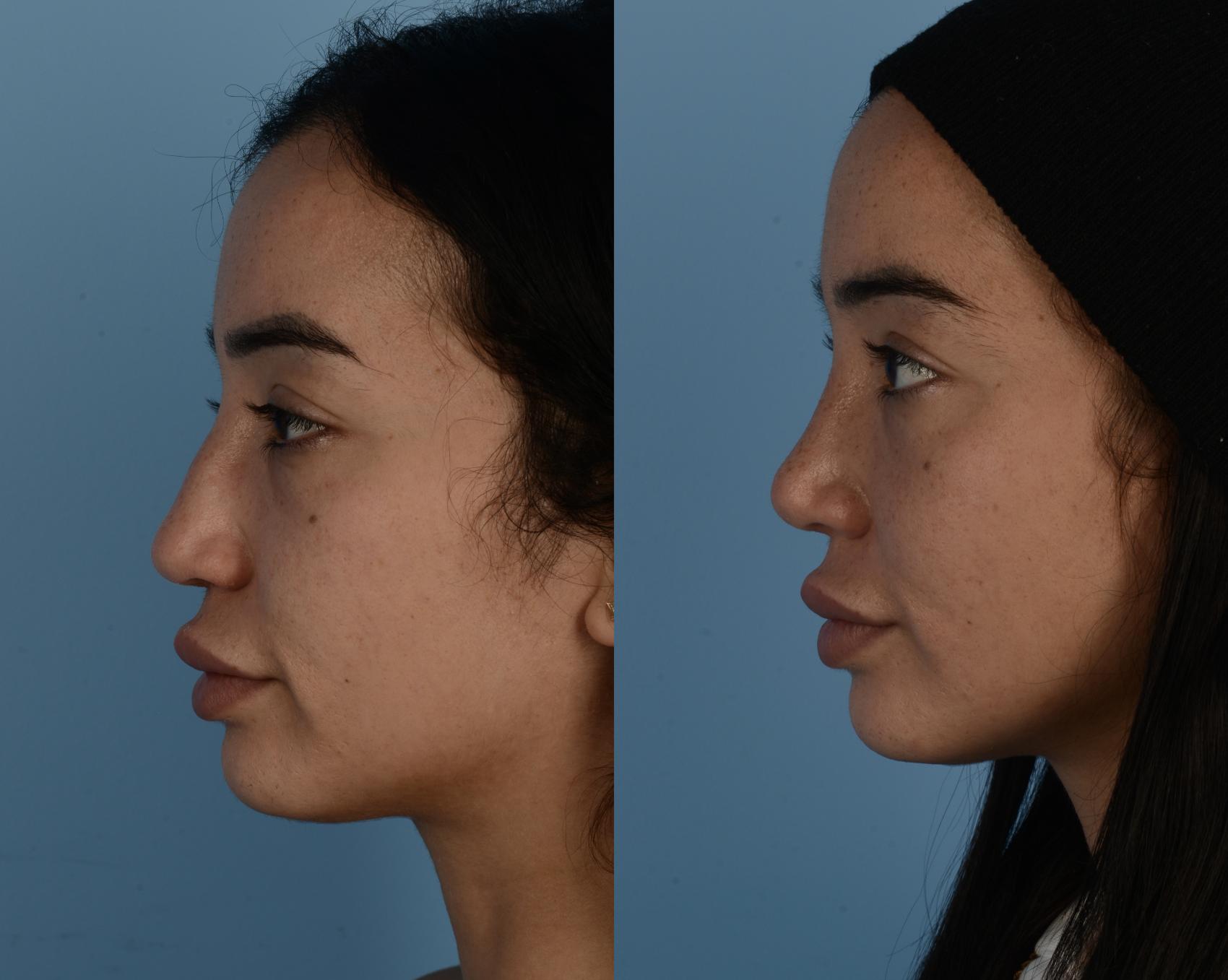 Before & After Rhinoplasty Case 233 View #1 View in Toronto, ON