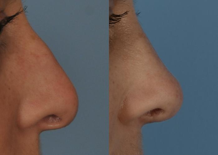 Before & After Rhinoplasty Case 235 View #1 View in Toronto, ON
