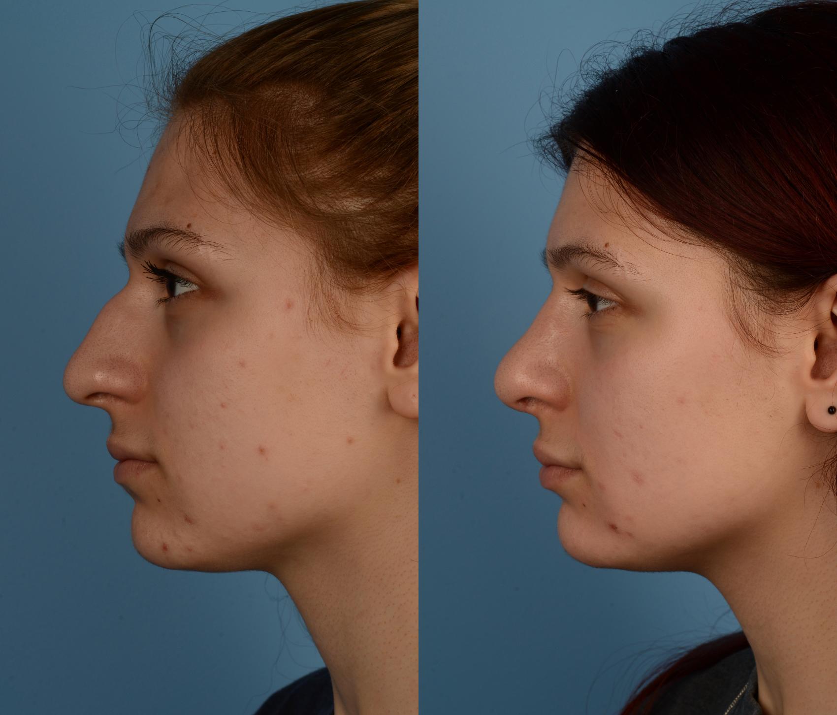 Before & After Rhinoplasty Case 237 View #1 View in Toronto, ON