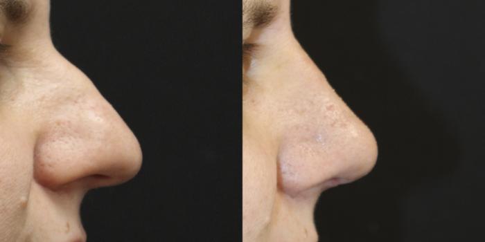 Before & After Rhinoplasty Case 263 Right Side View in Toronto, ON