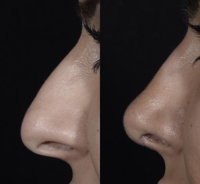 Before & After Rhinoplasty Case 269 Left Side View in Toronto, ON