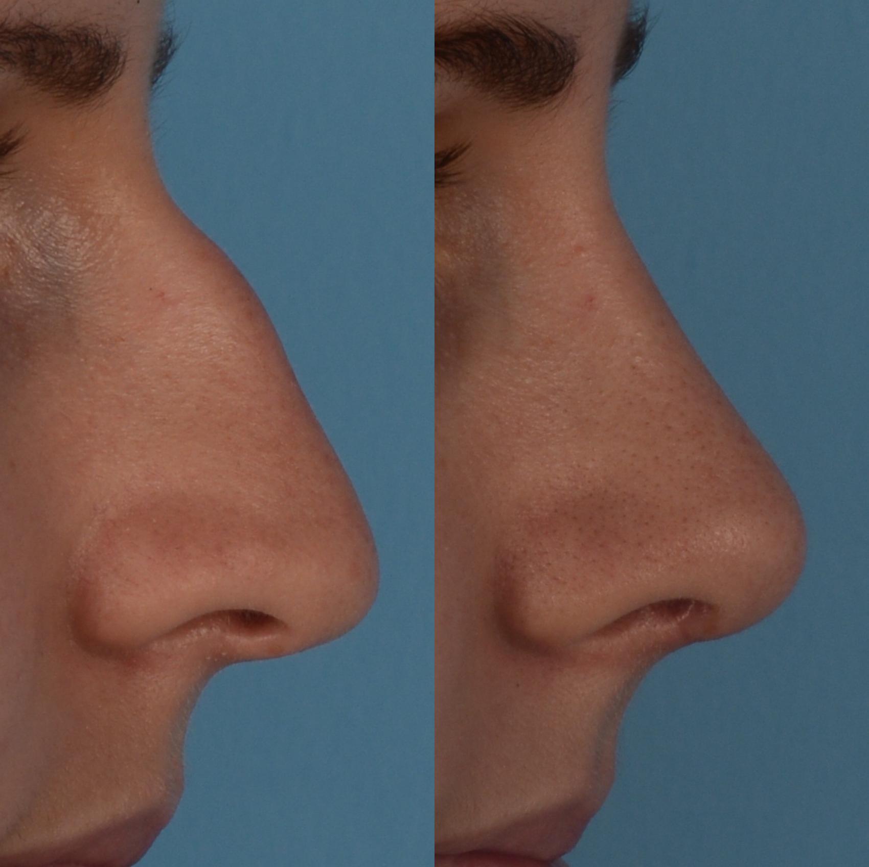 Before & After Rhinoplasty Case 289 Right Side View in Toronto, ON