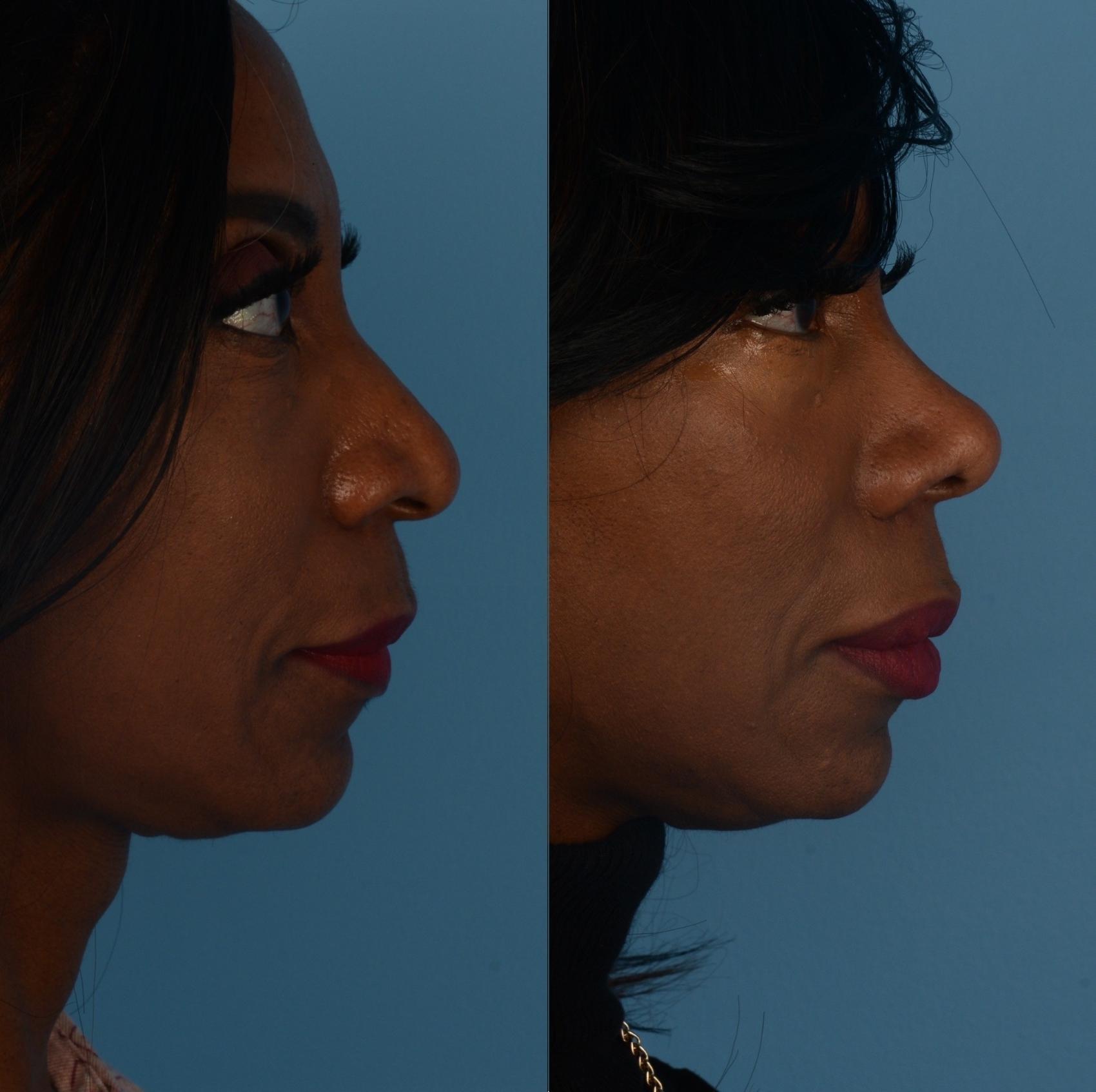 Before & After Rhinoplasty Case 290 Right Side View in Toronto, ON