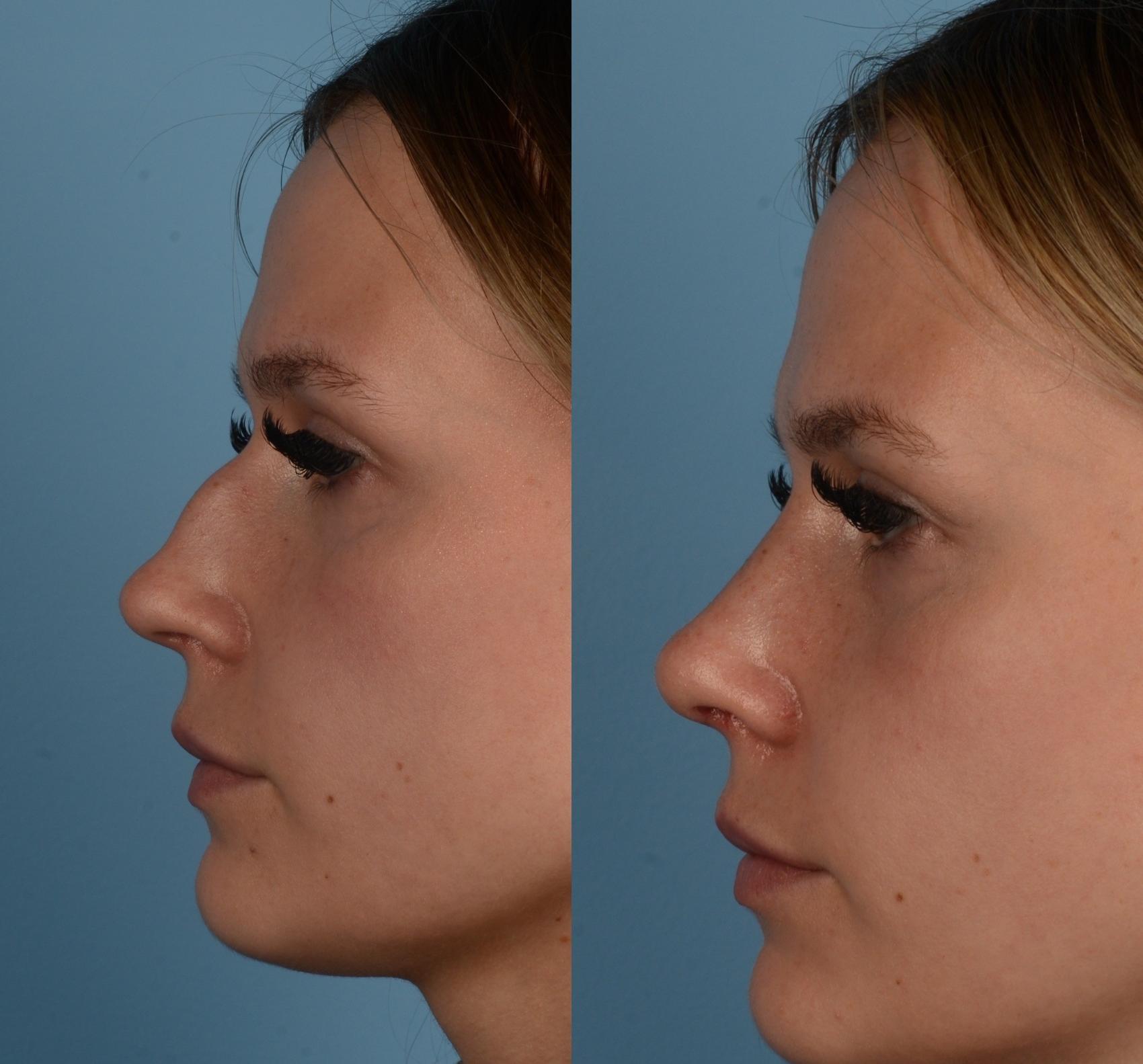 Before & After Rhinoplasty Case 291 Left Side View in Toronto, ON