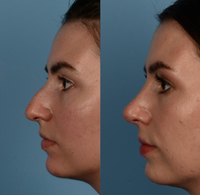 Before & After Rhinoplasty Case 292 Left Side View in Toronto, ON