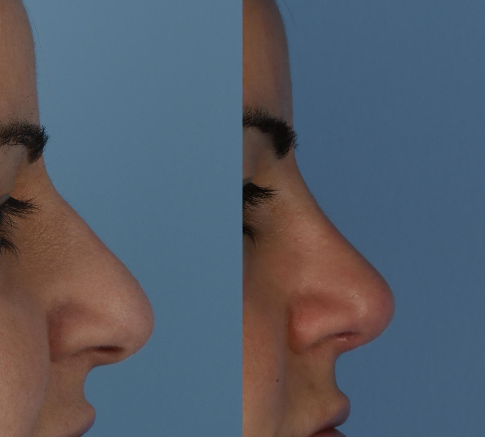 Rhinoplasty Before and After Photos, Dr. Steven Hanna, Toronto