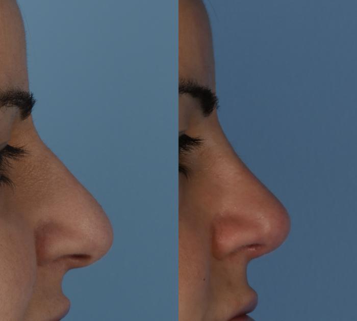 Rhinoplasty Before and After Photos, Dr. Steven Hanna, Toronto