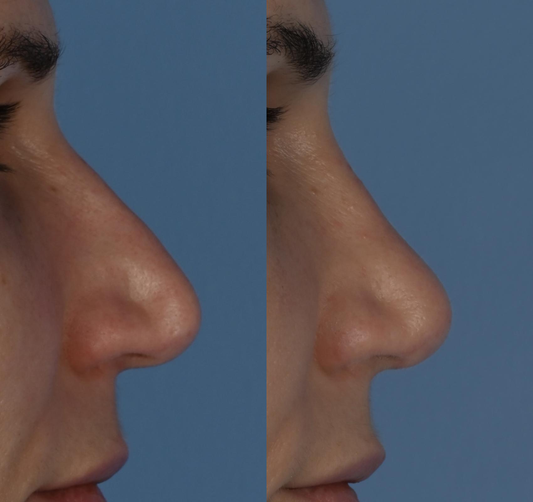 Rhinoplasty Before and After Photos, Dr. Steven Hanna, Toronto