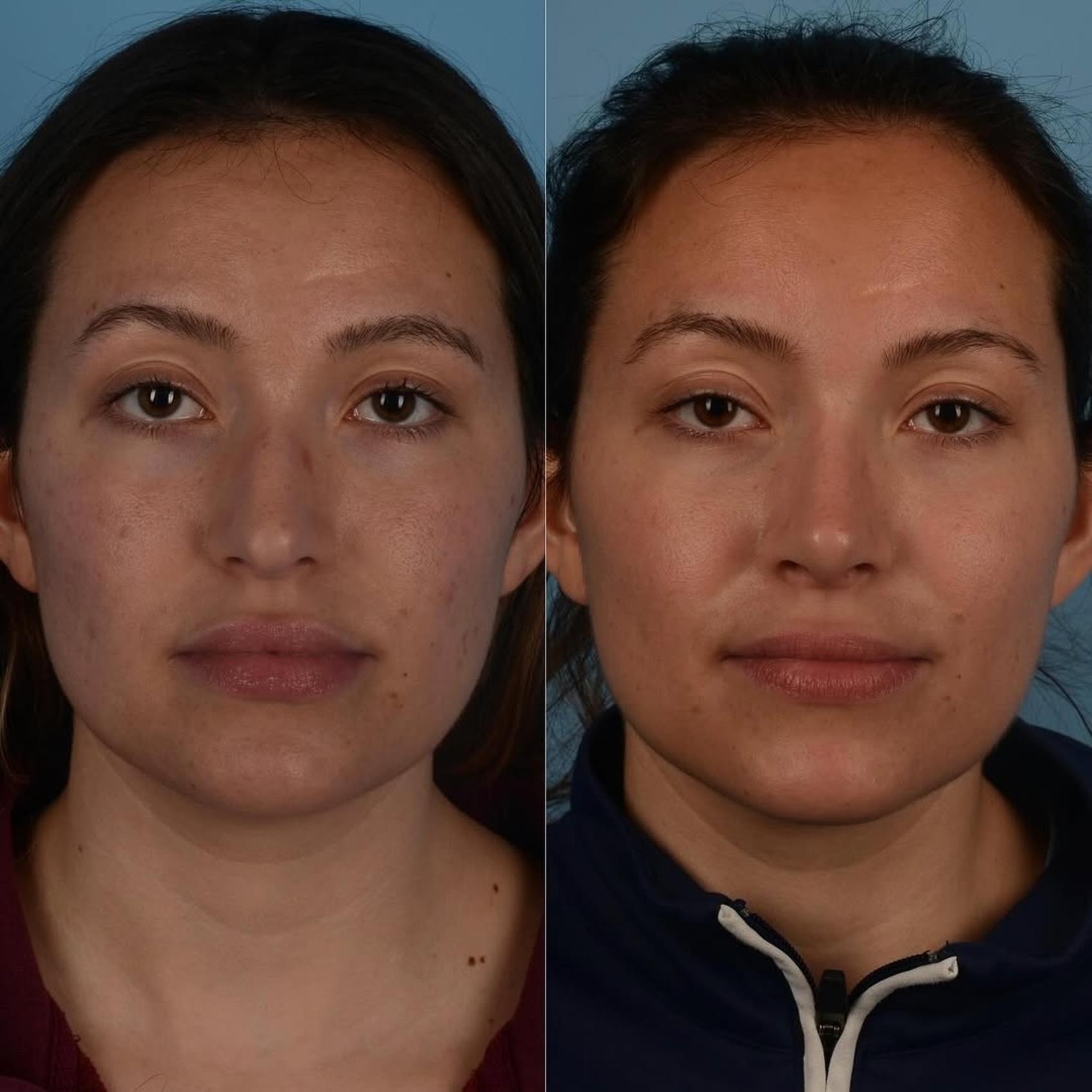 Before & After Rhinoplasty Case 325 Front View in Toronto, ON