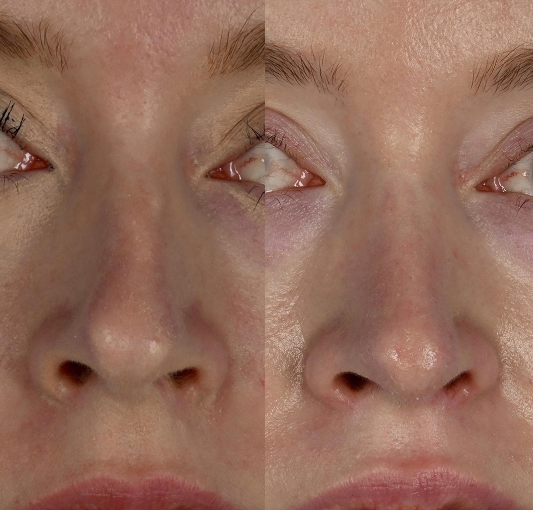 Before & After Rhinoplasty Case 341 Front View in Toronto, ON