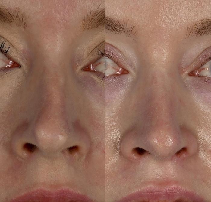 Before & After Rhinoplasty Case 341 Front View in Toronto, ON
