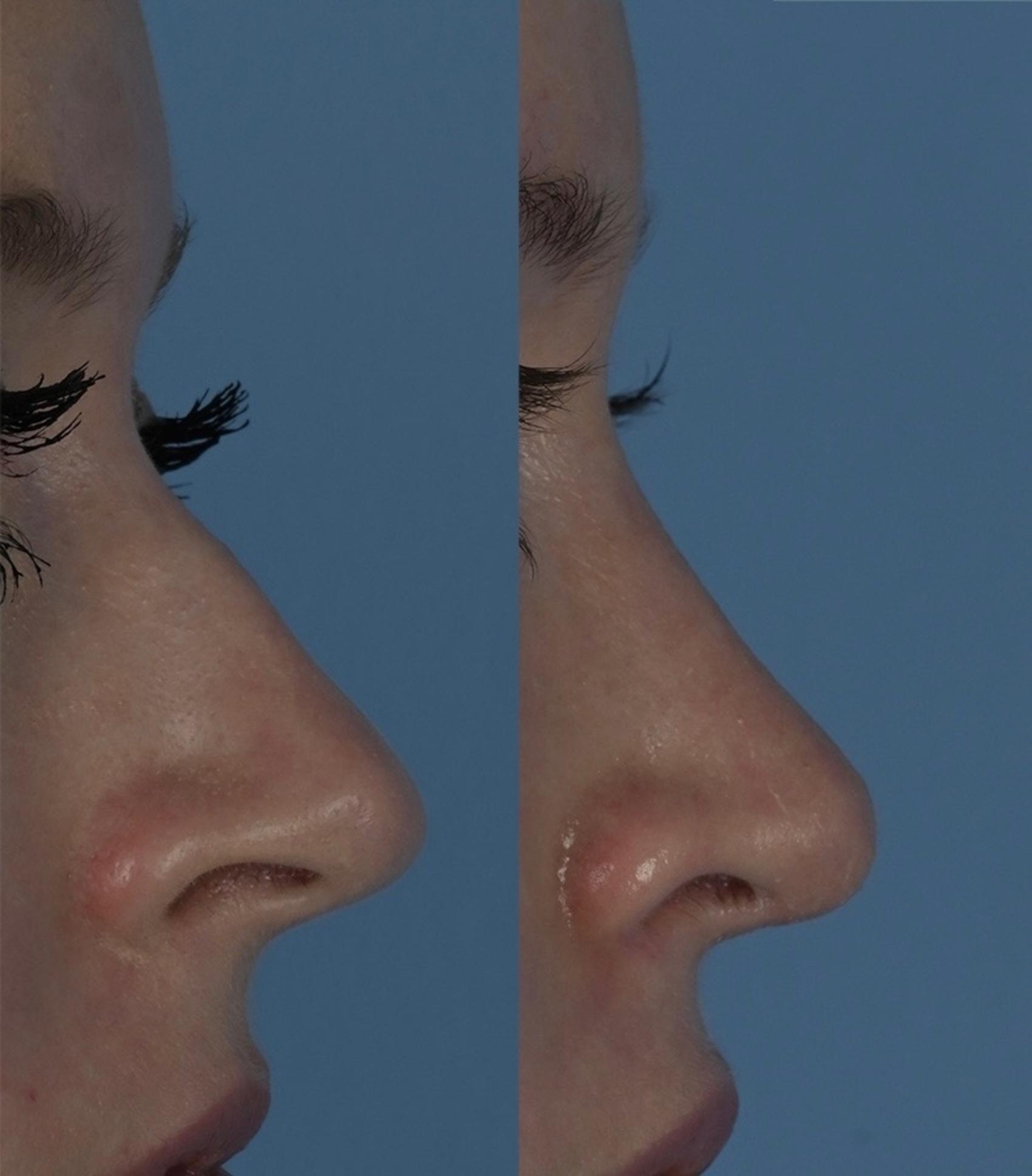 Before & After Rhinoplasty Case 341 Right Side View in Toronto, ON