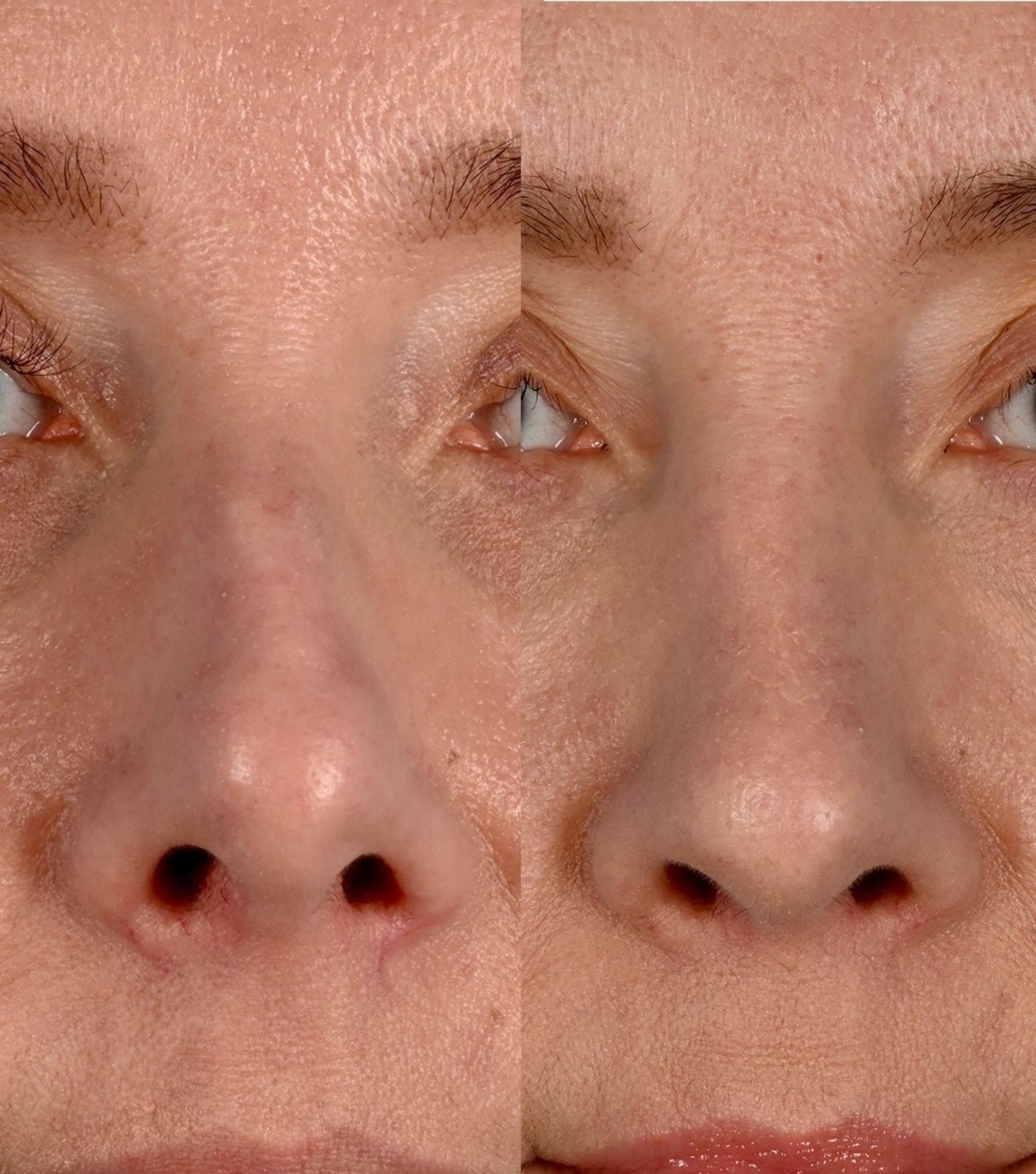Before & After Rhinoplasty Case 342 Front View in Toronto, ON