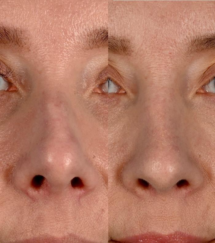 Before & After Rhinoplasty Case 342 Front View in Toronto, ON