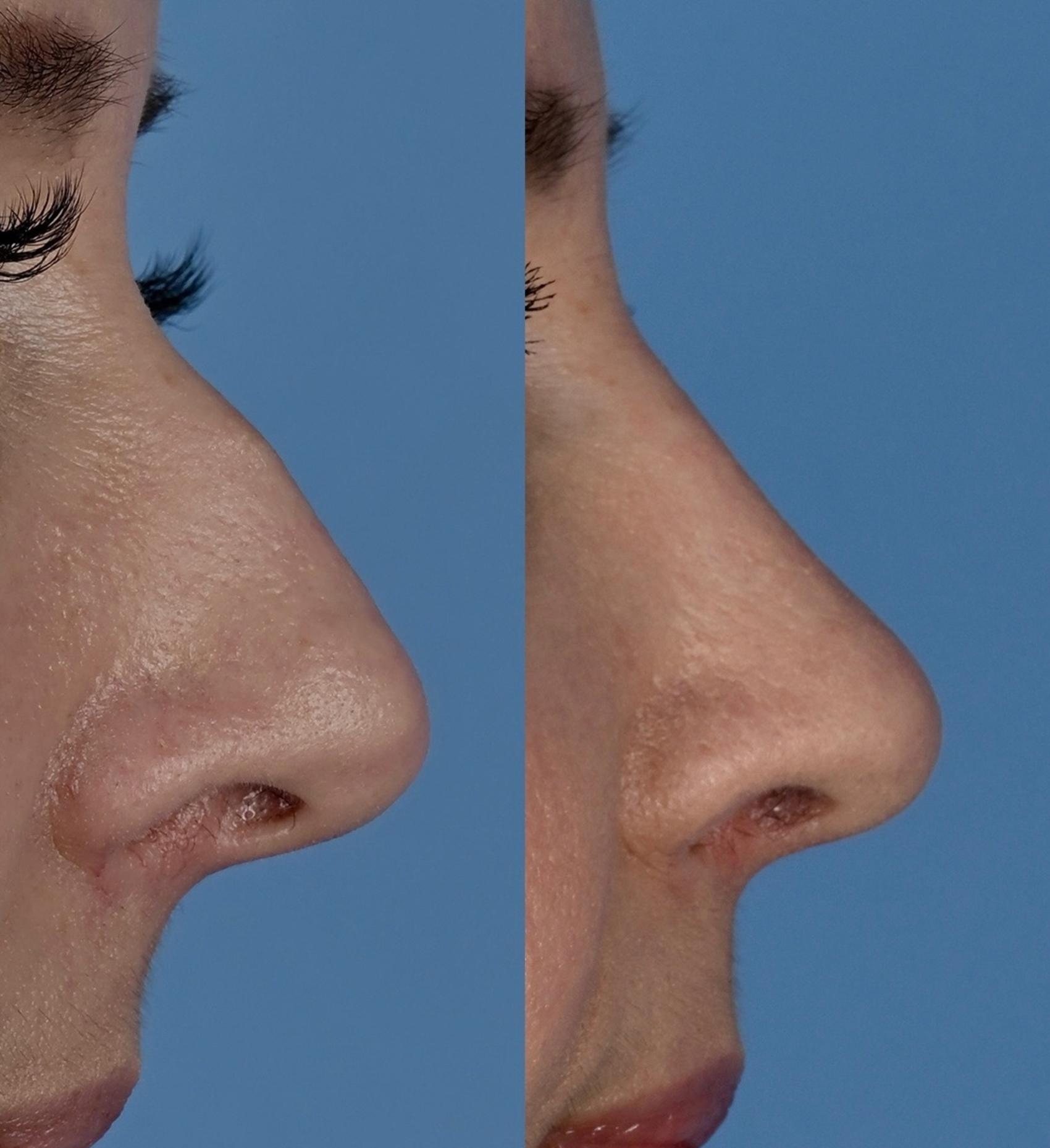 Before & After Rhinoplasty Case 342 Right Side View in Toronto, ON