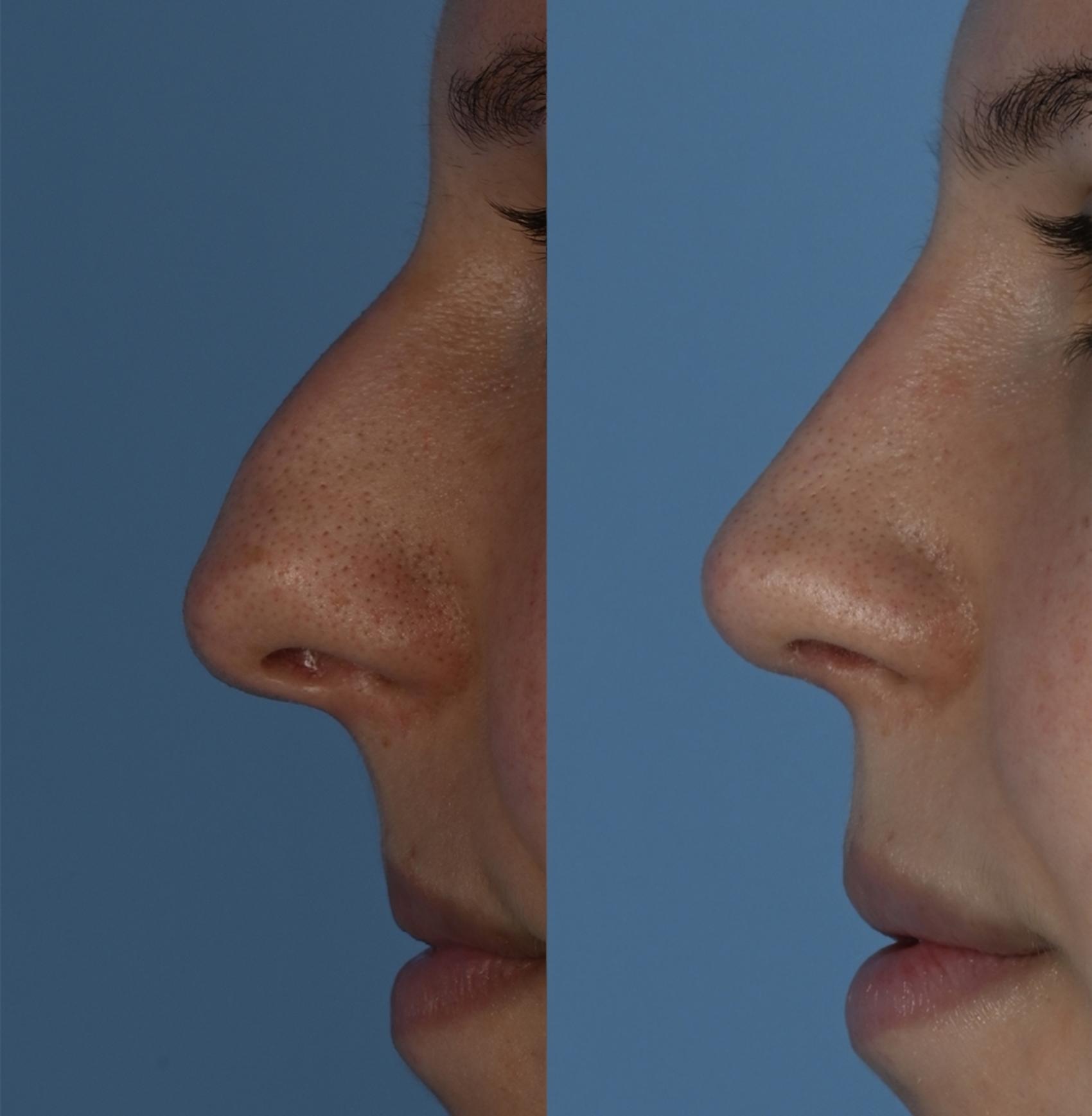 Before & After Rhinoplasty Case 344 Left Side View in Toronto, ON