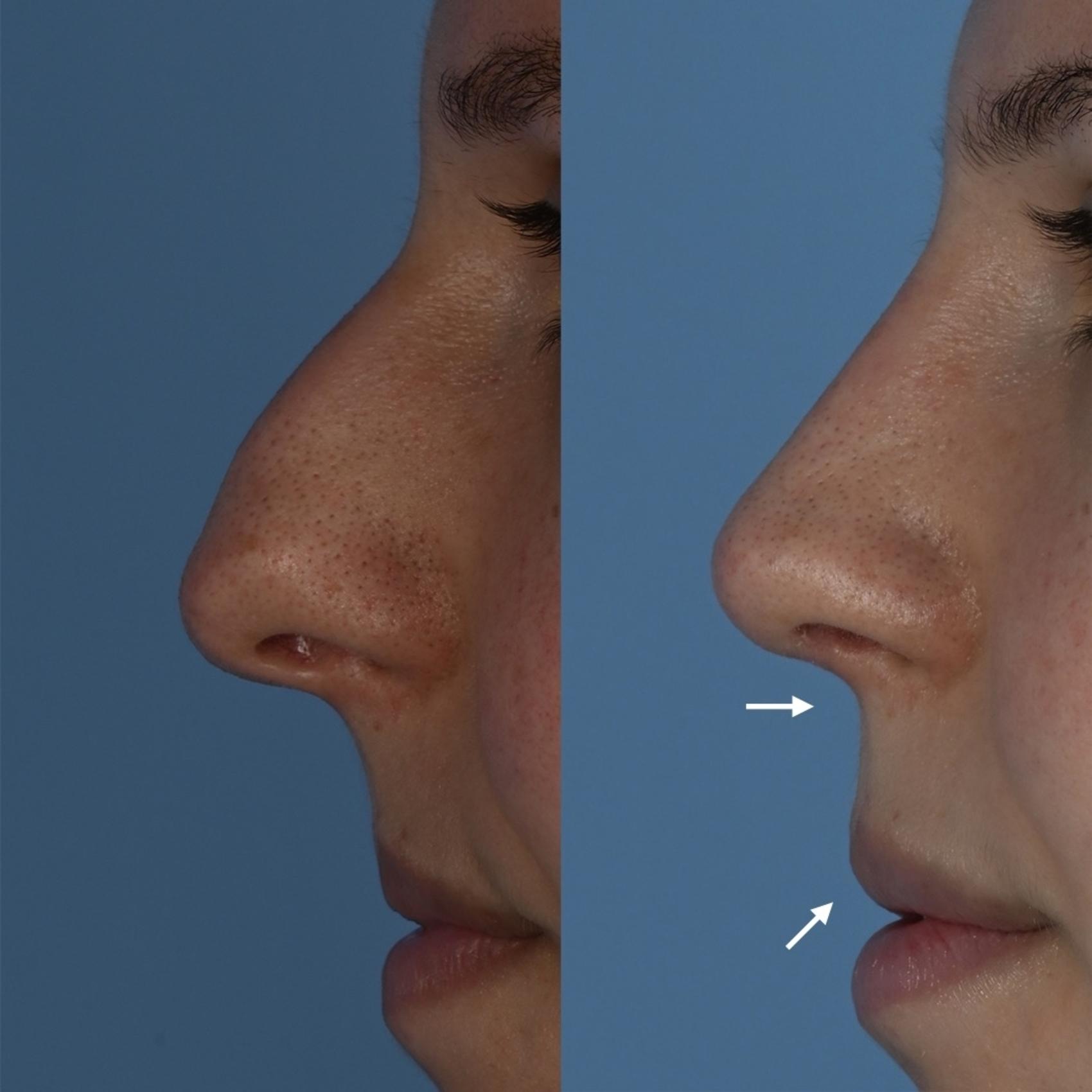 Before & After Rhinoplasty Case 344 Left Side with Labels View in Toronto, ON