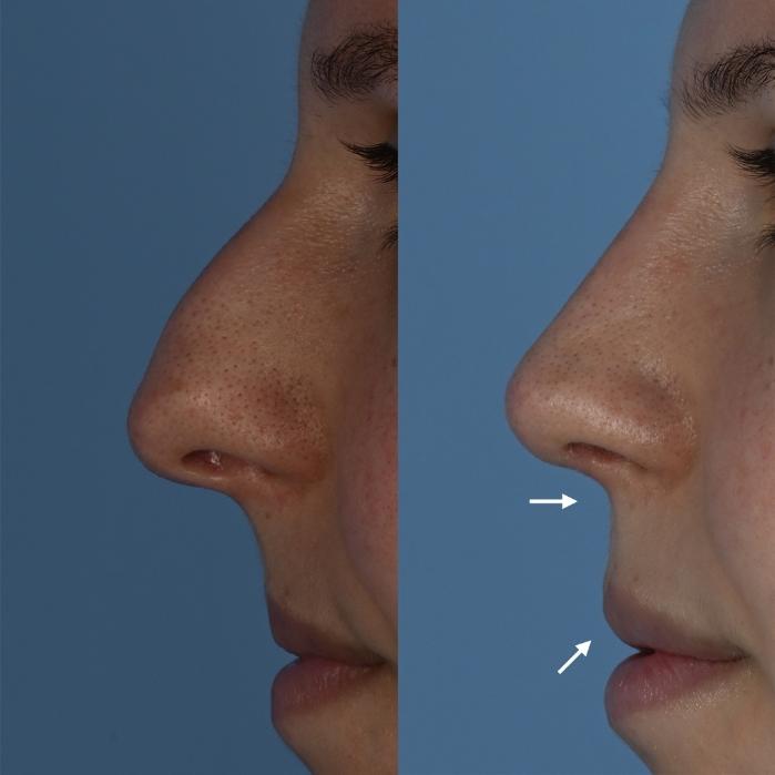 Before & After Rhinoplasty Case 344 Left Side with Labels View in Toronto, ON