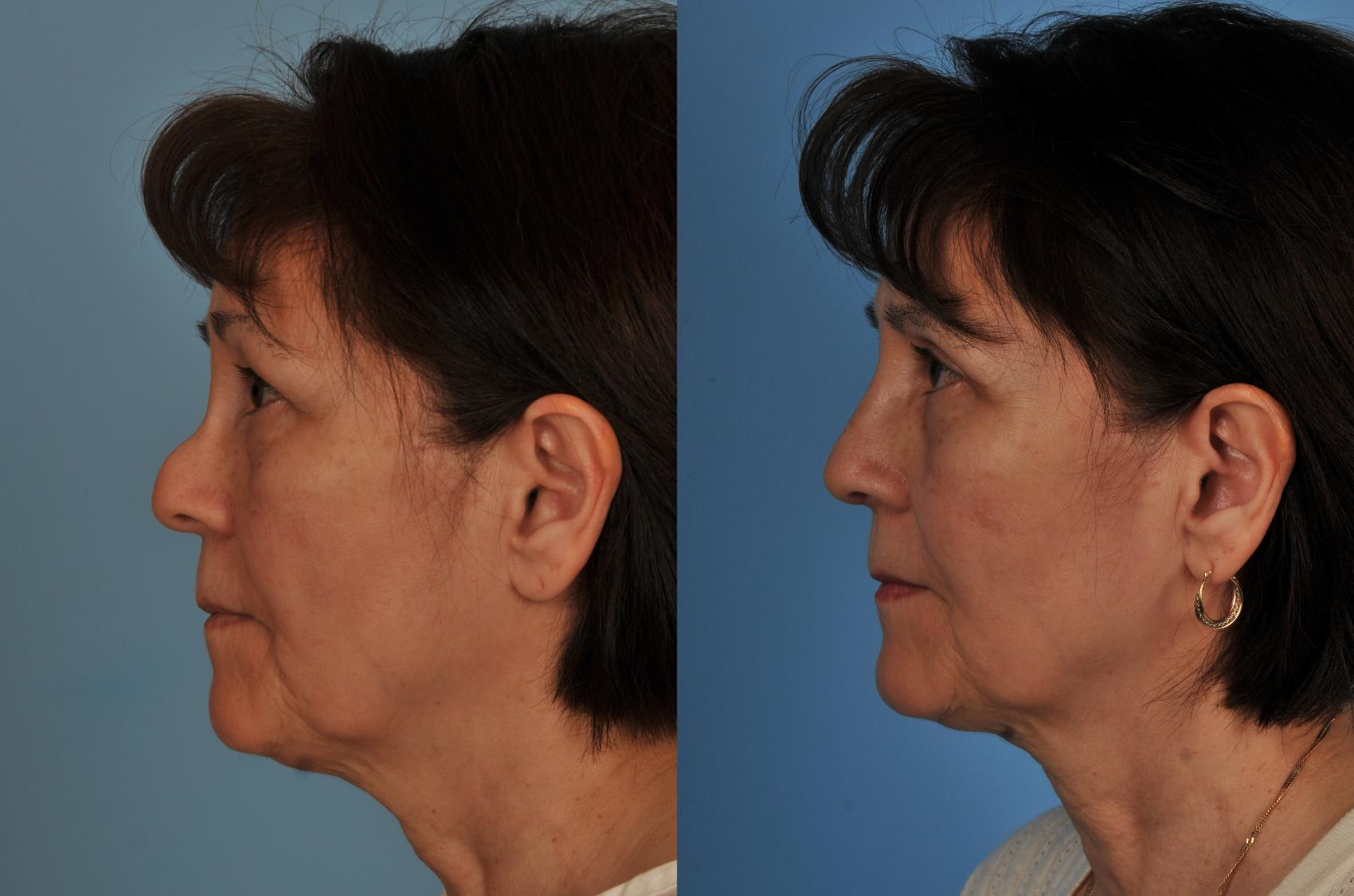 Before & After Rhinoplasty Case 72 View #1 View in Toronto, ON