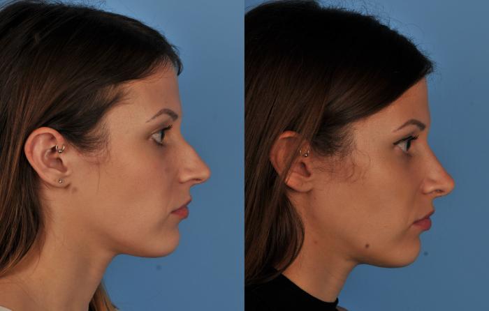 Before & After Rhinoplasty Case 75 View #1 View in Toronto, ON