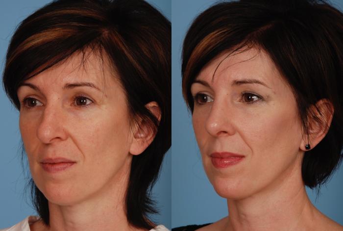 Before & After Rhinoplasty Case 76 View #1 View in Toronto, ON