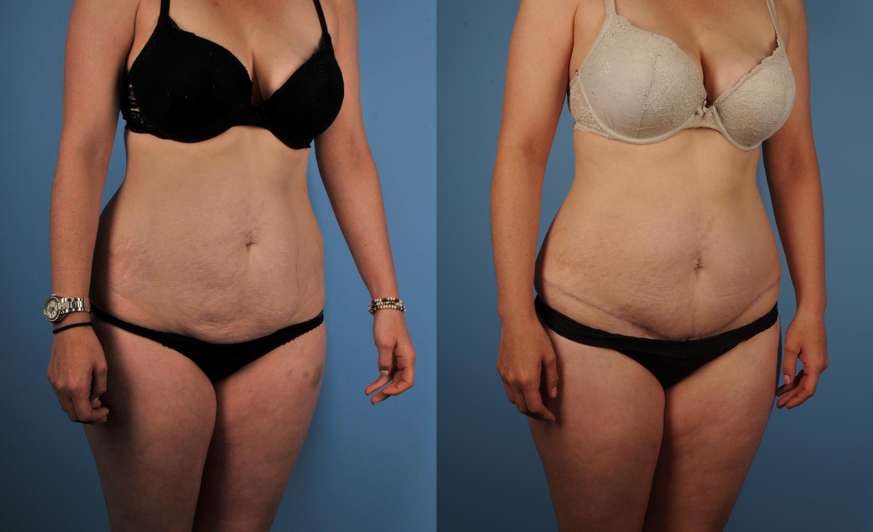 Before & After Tummy Tuck Case 126 View #1 View in Toronto, ON