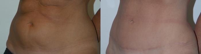 Before & After Tummy Tuck Case 139 View #1 View in Toronto, ON