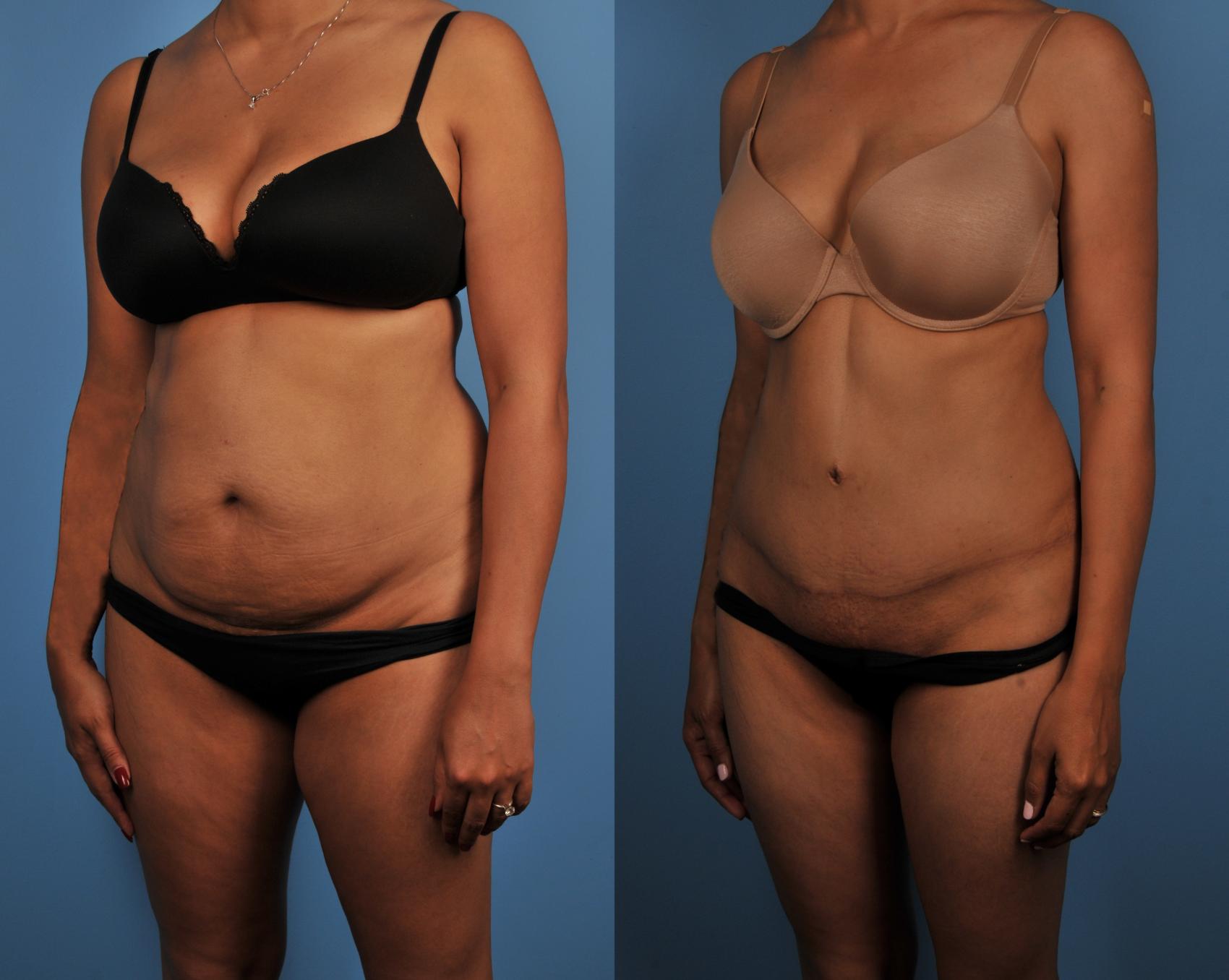 Before & After Tummy Tuck Case 140 View #1 View in Toronto, ON