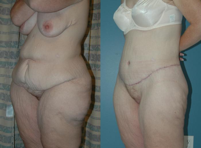 Before & After Tummy Tuck Case 141 View #1 View in Toronto, ON