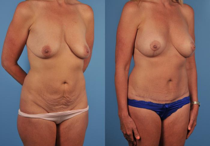 Before & After Tummy Tuck Case 149 View #1 View in Toronto, ON