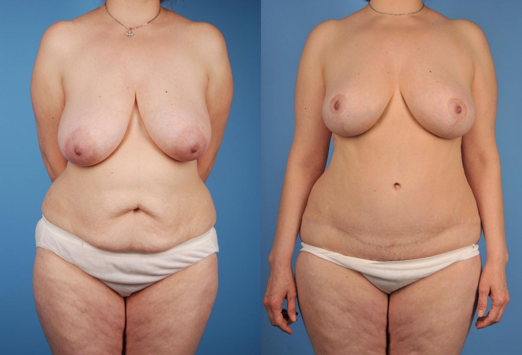 Before & After Tummy Tuck Case 16 View #1 View in Toronto, ON