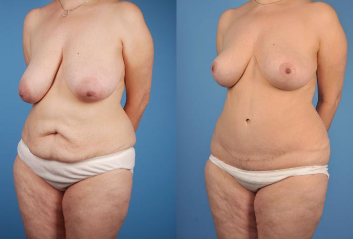 Before & After Tummy Tuck Case 16 View #2 View in Toronto, ON