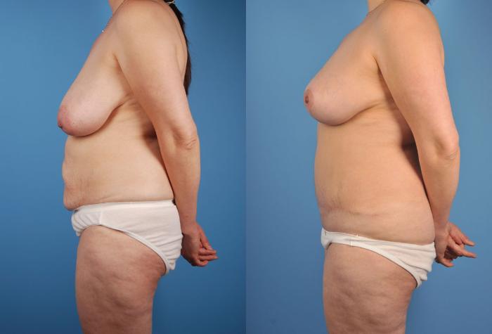 Before & After Tummy Tuck Case 16 View #3 View in Toronto, ON
