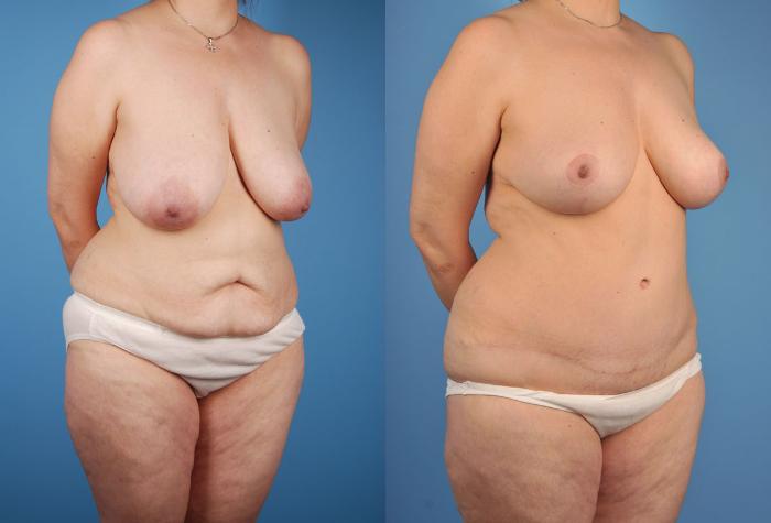 Before & After Tummy Tuck Case 16 View #4 View in Toronto, ON
