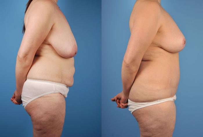 Before & After Tummy Tuck Case 16 View #5 View in Toronto, ON