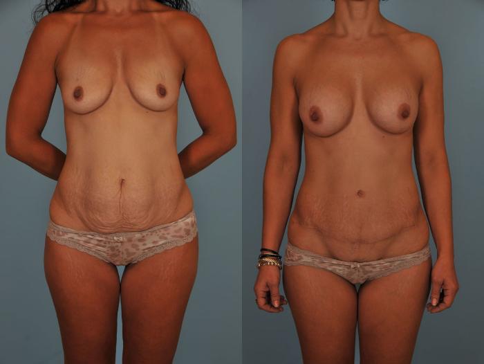 Before & After Tummy Tuck Case 17 View #1 View in Toronto, ON