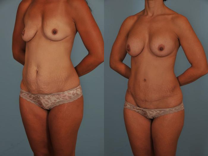 Before & After Tummy Tuck Case 17 View #2 View in Toronto, ON