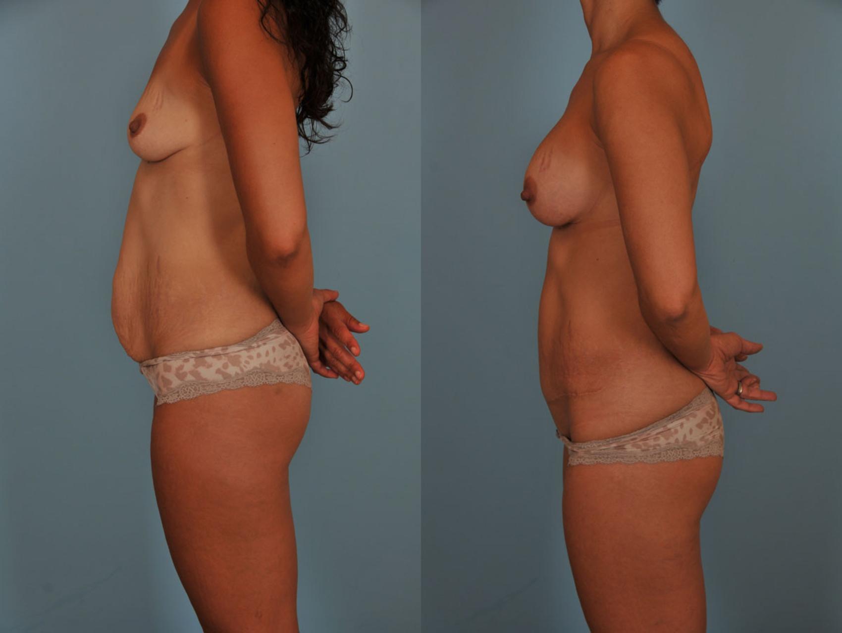 Before & After Tummy Tuck Case 17 View #3 View in Toronto, ON